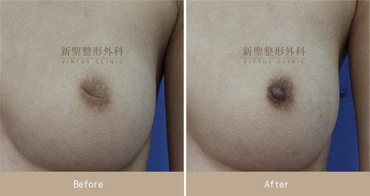 乳頭凹陷