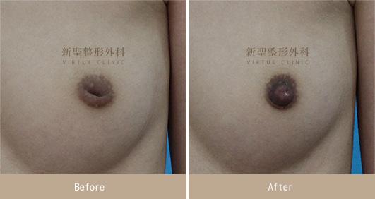 乳頭凹陷