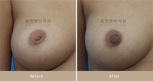 乳頭凹陷