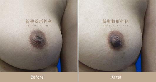 乳頭凹陷
