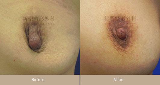 乳頭縮小