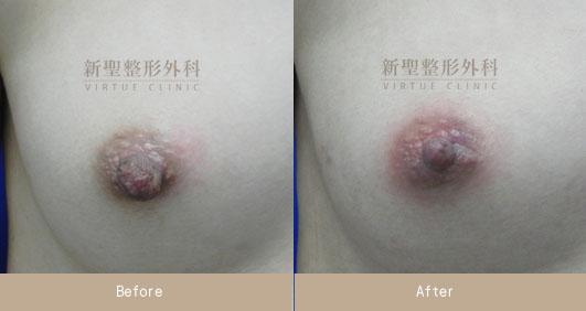 乳頭縮小