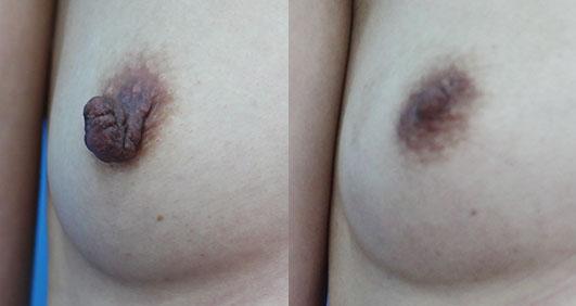 乳頭縮小