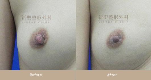 乳頭縮小