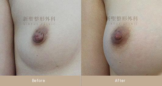 乳頭縮小