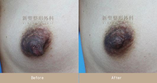乳頭縮小
