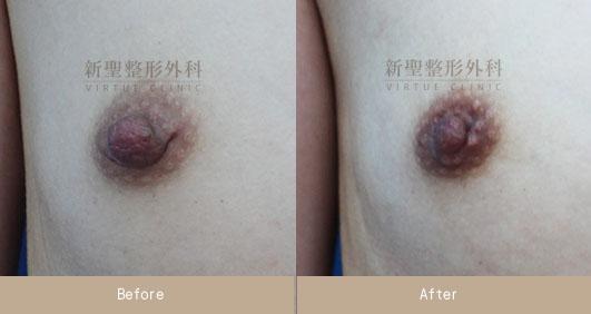 乳頭縮小