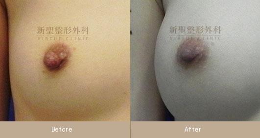 乳頭縮小