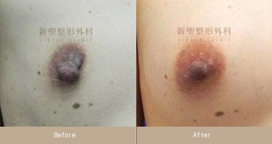 乳頭縮小
