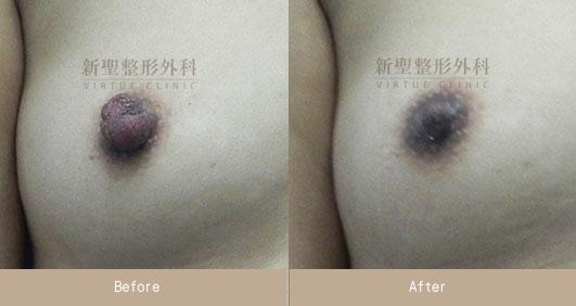 乳頭縮小