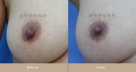 乳頭縮小