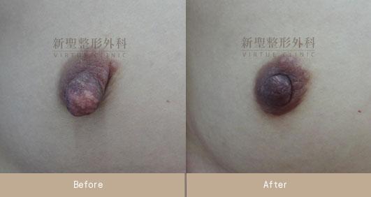 乳頭縮小