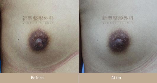 乳頭縮小