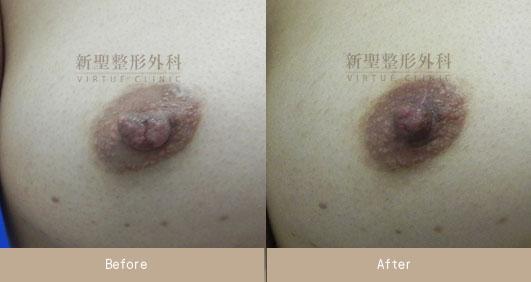 乳頭縮小