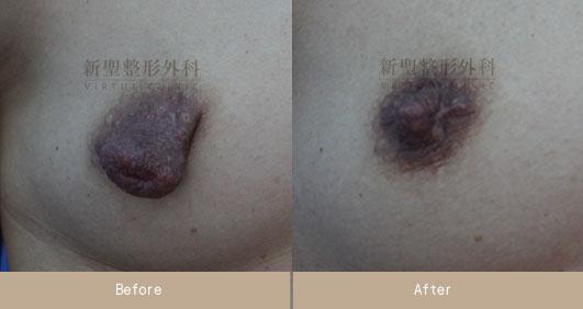 乳頭縮小