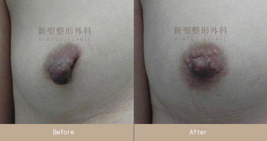 乳頭縮小