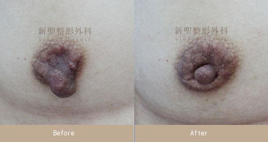 乳頭縮小