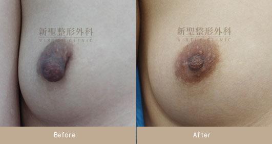乳頭縮小