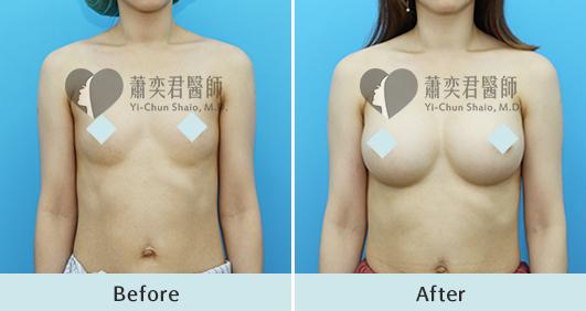 魔滴隆乳案例照片