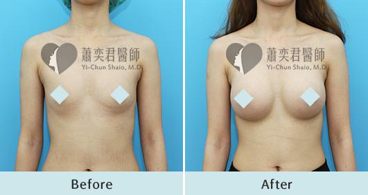 魔滴隆乳案例照片
