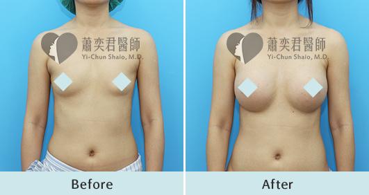 魔滴隆乳案例照片
