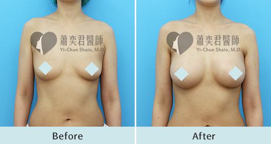 魔滴隆乳案例照片