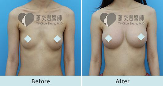 魔滴隆乳案例照片