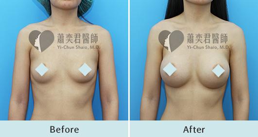 魔滴隆乳案例照片