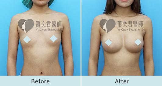 魔滴隆乳案例照片