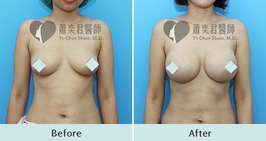 魔滴隆乳案例照片