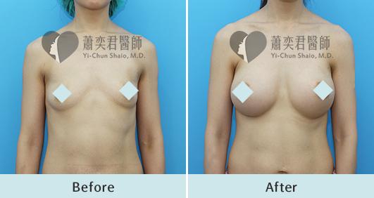 魔滴隆乳案例照片
