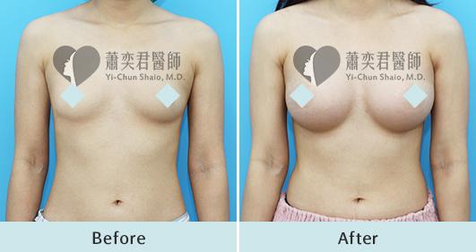 魔滴隆乳案例照片