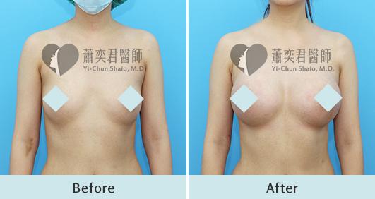 魔滴隆乳案例照片
