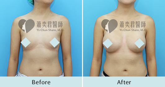 魔滴隆乳案例照片
