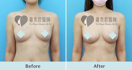 魔滴隆乳案例照片