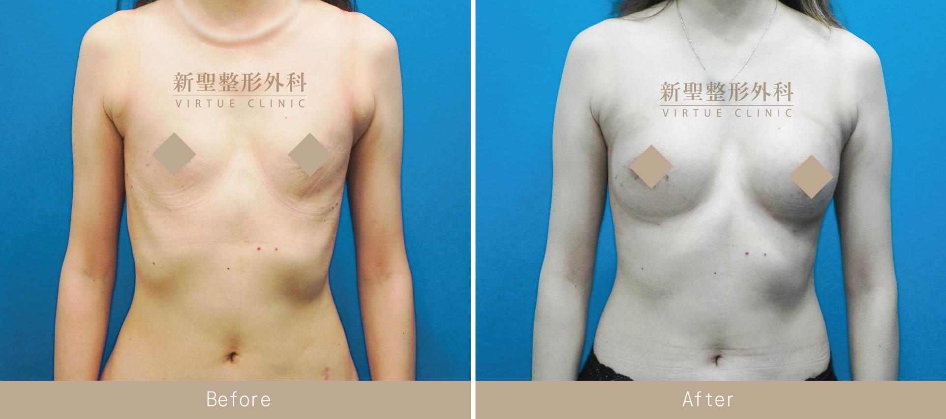 自體脂肪豐胸
