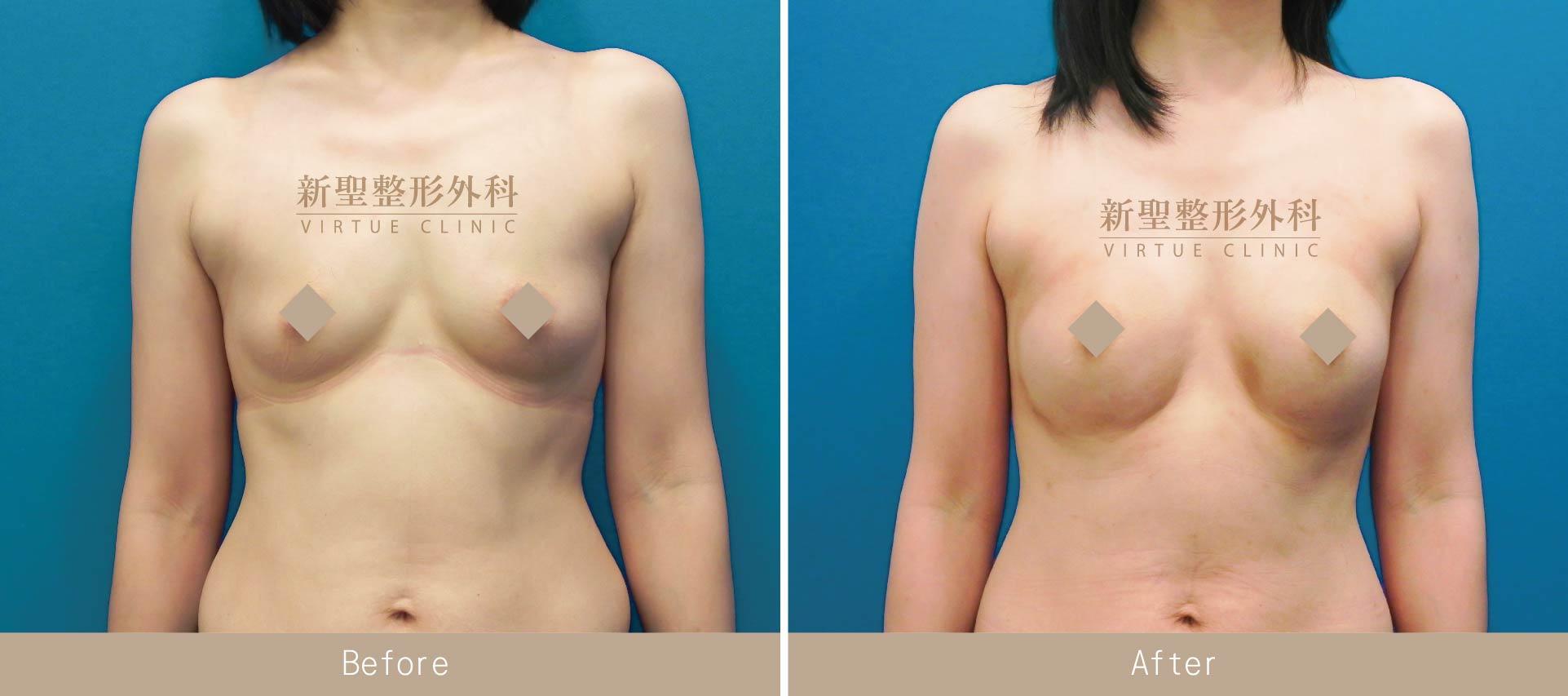 自體脂肪豐胸