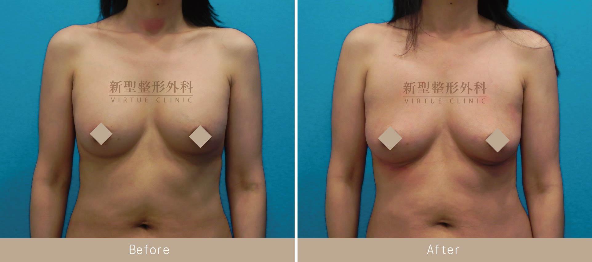 自體脂肪豐胸